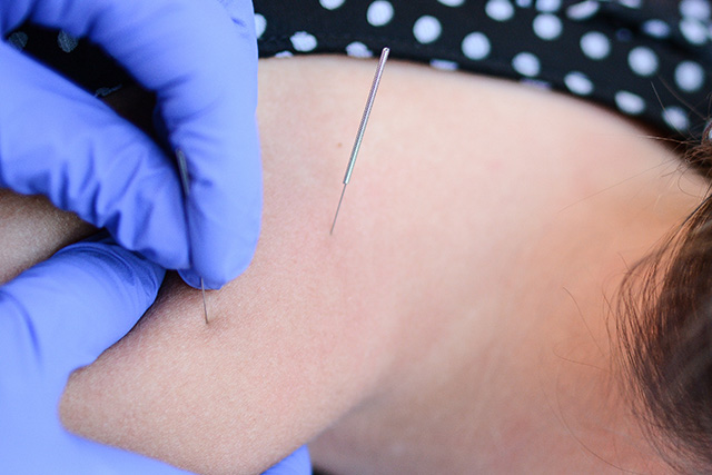Dry Needling